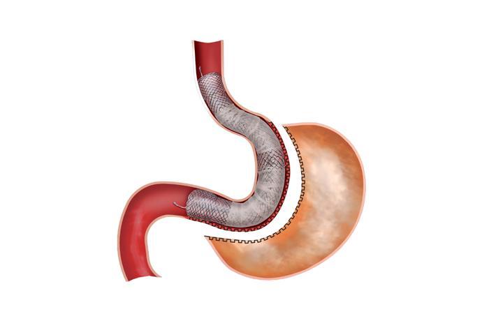 Gastro Seal™