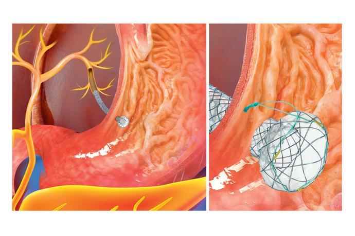 Hanarostent®Biliary (NC)